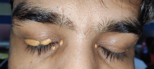 Bilateral xanthelasma.